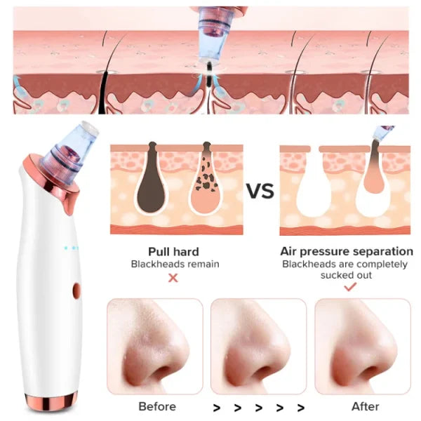 Vacuum Blackhead Remover Face Black Spots Cleaner White Dot Pimple Removal | Blackhead Remover For Nose,facial Pore Acne Grease Cleaner Skin Care